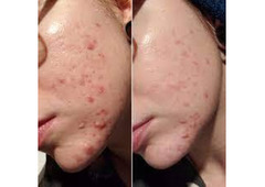Minocycline 100 mg as a Game-Changer for Breaking the Acne Barrier